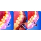 Matrice rýchloupínacie polyesterové moláry/premoláry